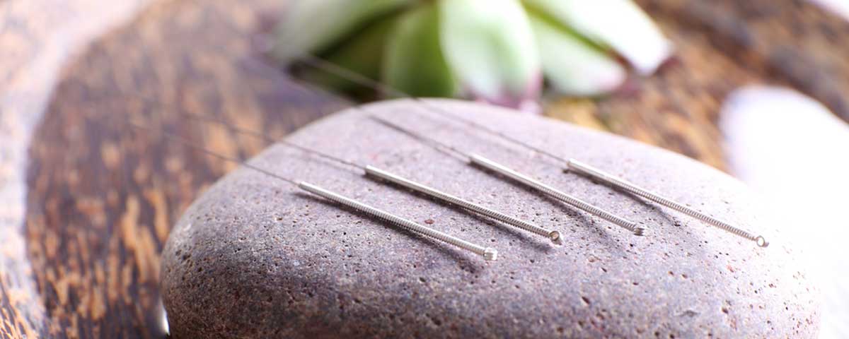 Acupuncture | Acupuncture, Holistic & Naturopathic Medicine Specialist ...